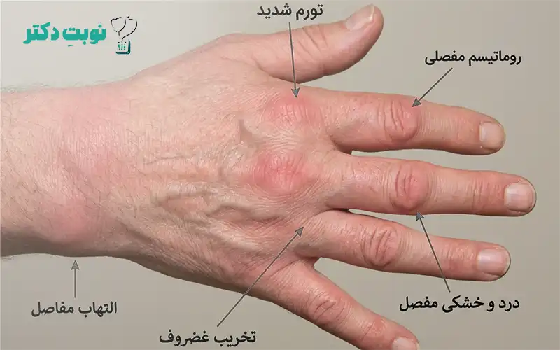 اینفوگرافی آناتومی آرتریت روماتوئید
