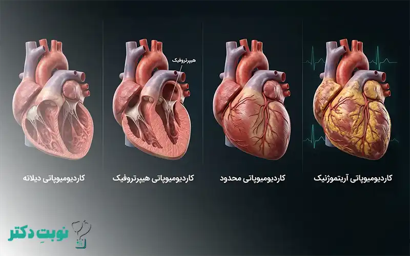 انواع کاردیومیوپاتی