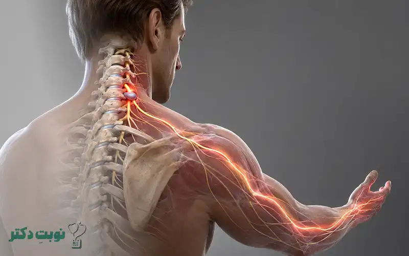 درگیری عصب در دیسک گردن