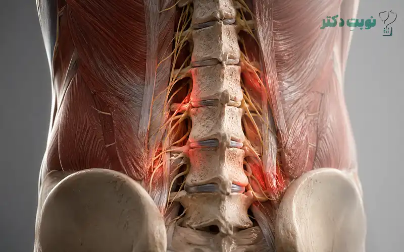 علتهای عضلانی و دیسکی کمردرد