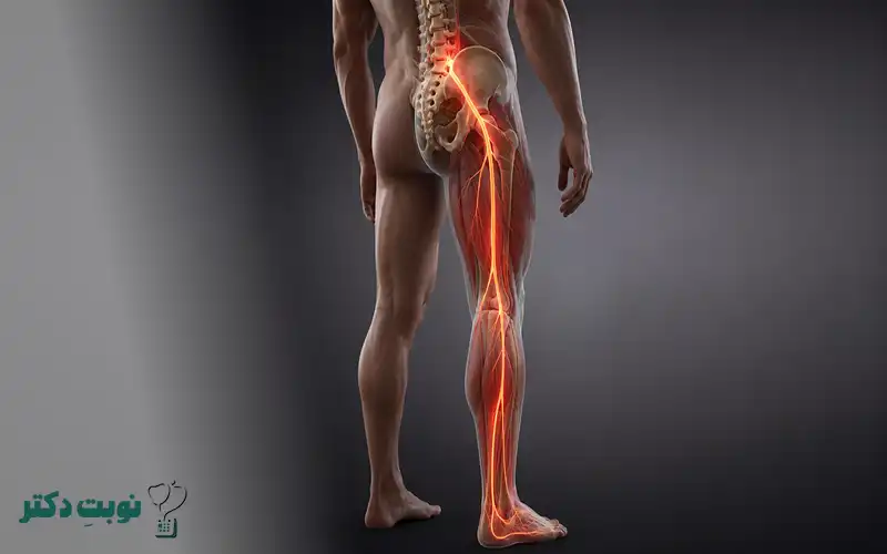 درد سیاتیکی و انتشار کمردرد به پا