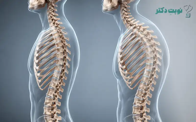 قوس پشتی ستون