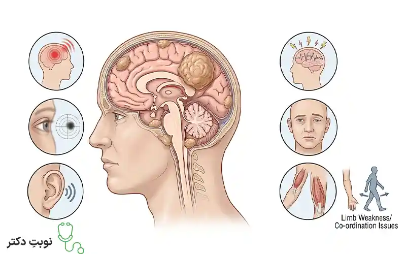 علائم مننژیوم