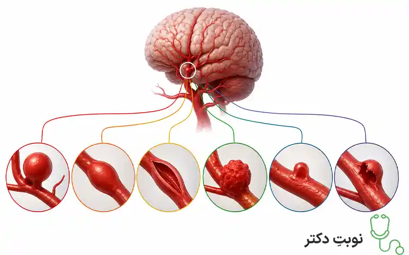انواع آنوریسم مغزی