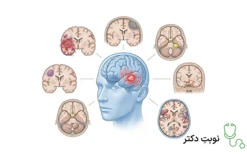 انواع تومور مغزی