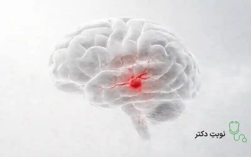 علت خونریزی مغزی چیست